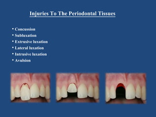 Injuries To The Periodontal Tissues
• Concussion
• Subluxation
• Extrusive luxation
• Lateral luxation
• Intrusive luxation
• Avulsion
 