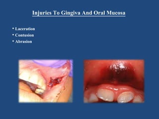 Injuries To Gingiva And Oral Mucosa
• Laceration
• Contusion
• Abrasion
 