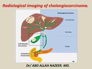 Dr/ ABD ALLAH NAZEER. MD.
Radiological imaging of cholangiocarcinoma.
 