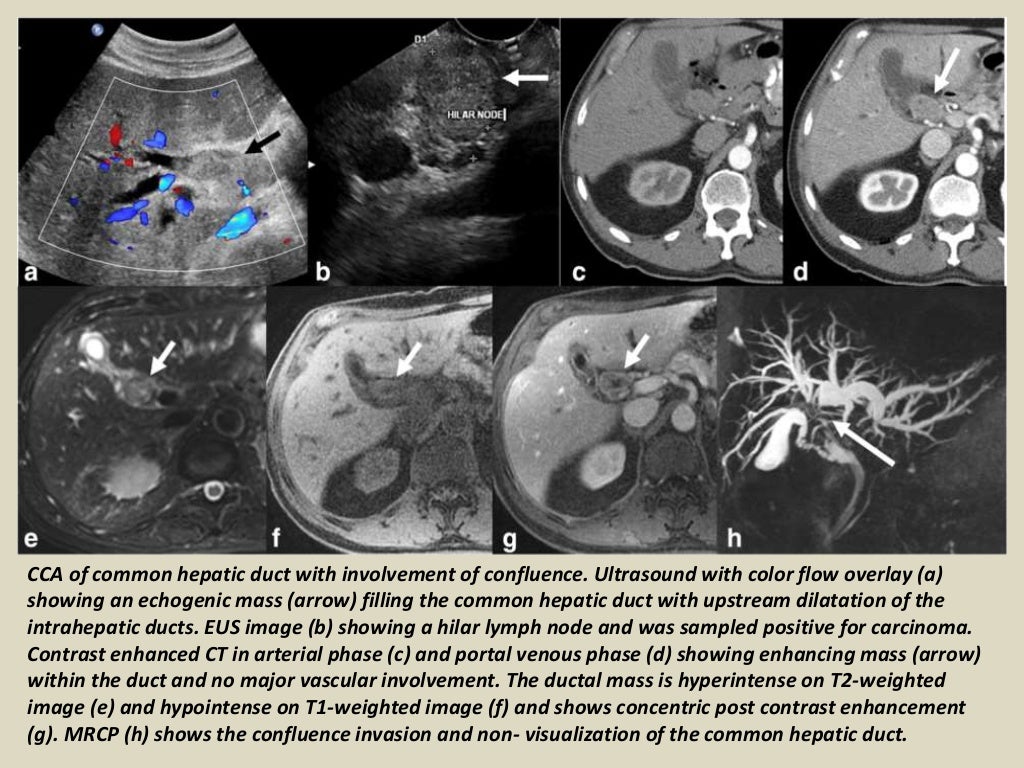 Presentation1.pptx, radiological imaging of cholangiocarcinoma.