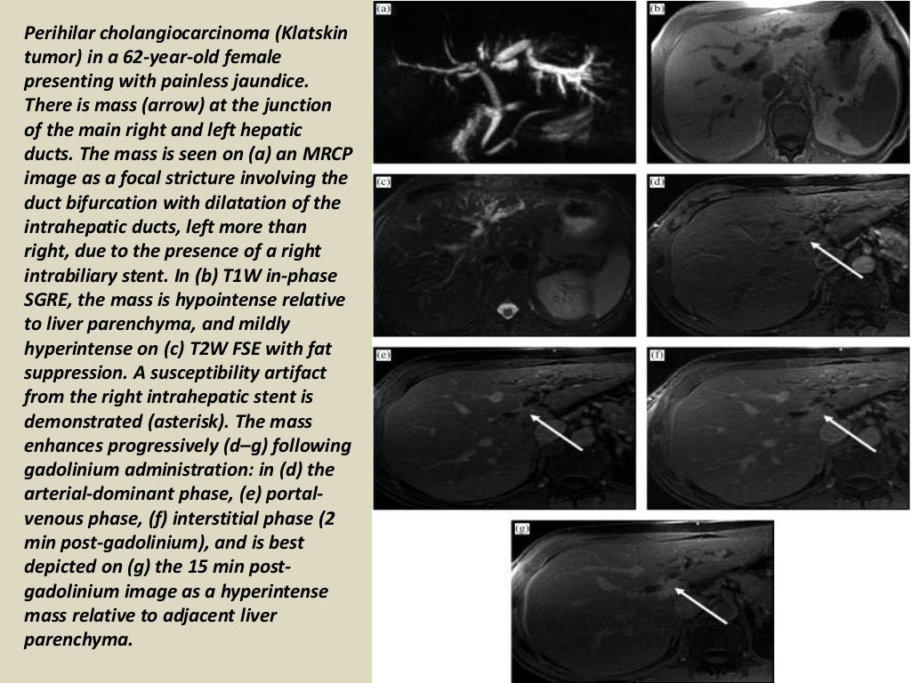 Presentation1.pptx, radiological imaging of cholangiocarcinoma.
