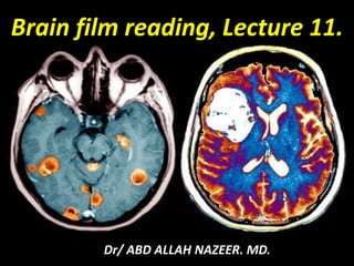 Dr/ ABD ALLAH NAZEER. MD.
Brain film reading, Lecture 11.
 