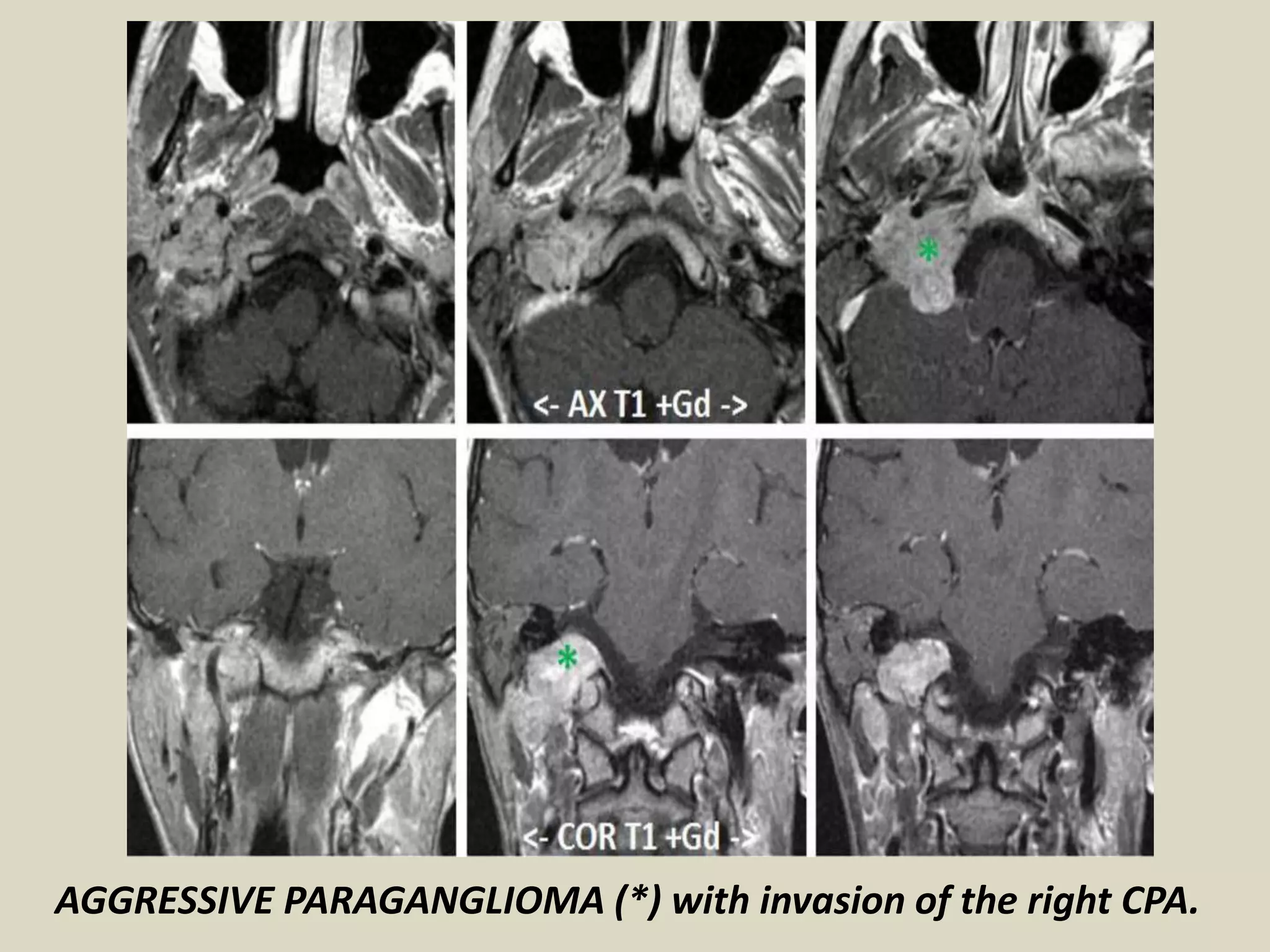 Presentation1.pptx, radiological imaging of cerebello pontine angle ...