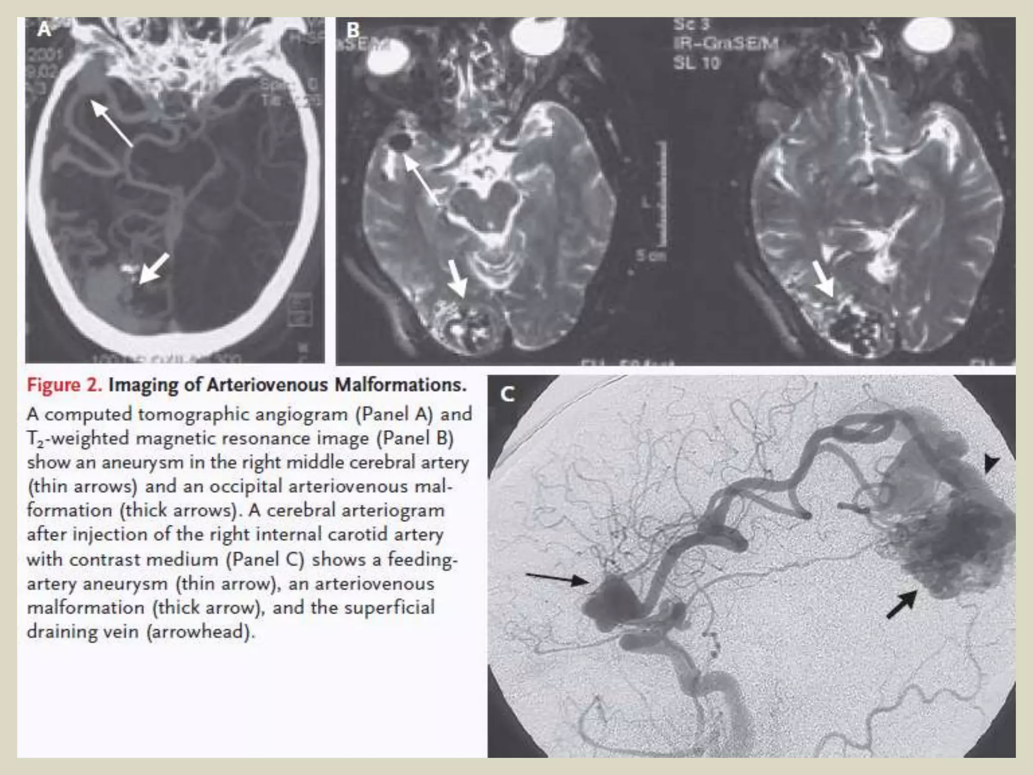 Presentation1.pptx, radiological imaging of brain av malformation. | PPTX
