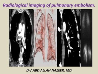 Dr/ ABD ALLAH NAZEER. MD.
Radiological imaging of pulmonary embolism.
 