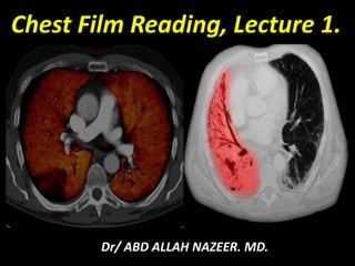 Chest Film Reading, Lecture 1.
Dr/ ABD ALLAH NAZEER. MD.
 