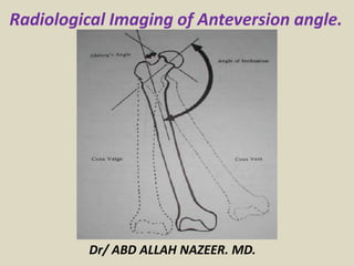 Dr/ ABD ALLAH NAZEER. MD.
Radiological Imaging of Anteversion angle.
 