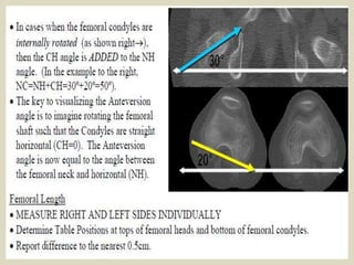 Presentation1.pptx, radiological imaging of anteversion angle. | PPTX