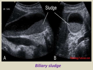 Presentation1.pptx, ultrasound examination of the liver and gall ...