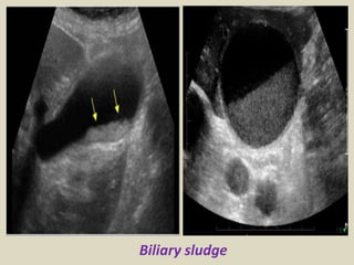 Presentation1.pptx, ultrasound examination of the liver and gall ...
