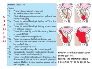 Invasion into the prostatic apex
or into (but not
beyond) the prostatic capsule
is classified not as T3 but as T2.
S
T
A
G
I
N
G
 
