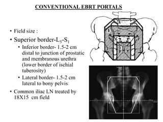 CONVENTIONAL EBRT PORTALS
• Field size :
• Superior border-L5-S1
• Inferior border- 1.5-2 cm
distal to junction of prostatic
and membranous urethra
(lower border of ischial
tuberosity)
• Lateral border- 1.5-2 cm
lateral to bony pelvis
• Common iliac LN treated by
18X15 cm field
 