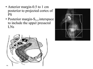 • Anterior margin-0.5 to 1 cm
posterior to projected cortex of
PS
• Posterior margin-S2-3 interspace
to include the upper presacral
LNs
 
