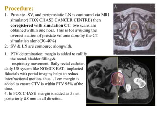 Procedure:
1. Prostate , SV, and periprostatic LN is contoured via MRI
simulator( FOX CHASE CANCER CENTRE) then
coregistered with simulation CT. two scans are
obtained within one hour. This is for avoiding the
overestimation of prostate volume done by the CT
simulation alone(30-40%)
2. SV & LN are contoured alongwith.
1. PTV determination: margin is added to nullify
the rectal, bladder filling &
respiratory movement. Daily rectal catheter,
daily US system like NOMOS BAT, implanted
fiducials with portal imaging helps to reduce
interfractional motion- thus 1.1 cm margin is
added to ensure CTV is within PTV 95% of the
time.
4. In FOX CHASE margin is added as 5 mm
posteriorly &8 mm in all direction.
 