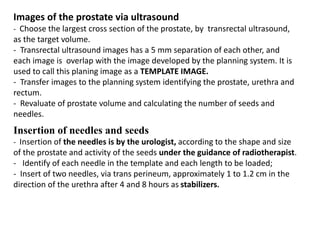 Images of the prostate via ultrasound
- Choose the largest cross section of the prostate, by transrectal ultrasound,
as the target volume.
- Transrectal ultrasound images has a 5 mm separation of each other, and
each image is overlap with the image developed by the planning system. It is
used to call this planing image as a TEMPLATE IMAGE.
- Transfer images to the planning system identifying the prostate, urethra and
rectum.
- Revaluate of prostate volume and calculating the number of seeds and
needles.
Insertion of needles and seeds
- Insertion of the needles is by the urologist, according to the shape and size
of the prostate and activity of the seeds under the guidance of radiotherapist.
- Identify of each needle in the template and each length to be loaded;
- Insert of two needles, via trans perineum, approximately 1 to 1.2 cm in the
direction of the urethra after 4 and 8 hours as stabilizers.
 