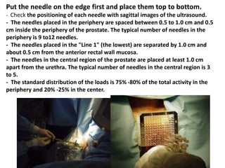 Put the needle on the edge first and place them top to bottom.
- Check the positioning of each needle with sagittal images of the ultrasound.
- The needles placed in the periphery are spaced between 0.5 to 1.0 cm and 0.5
cm inside the periphery of the prostate. The typical number of needles in the
periphery is 9 to12 needles.
- The needles placed in the "Line 1" (the lowest) are separated by 1.0 cm and
about 0.5 cm from the anterior rectal wall mucosa.
- The needles in the central region of the prostate are placed at least 1.0 cm
apart from the urethra. The typical number of needles in the central region is 3
to 5.
- The standard distribution of the loads is 75% -80% of the total activity in the
periphery and 20% -25% in the center.
 