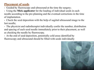 Placement of seeds
- Guided by fluoroscopy and ultrasound at the time the surgery;
- Using the Mick applicator for the loading of individual seeds in each
needle according to the pre-planning and the eventual corrections in the time
of implantation.
- Check the seed deposition with the help of sagittal ultrasound image to the
last needle;
- The physicist and radiotherapist individually confer the number, distribution
and spacing of each seed needle immediately prior to their placement, as well
as checking the needle by fluoroscopy.
- At the end of seed deposition, potentially cold areas identified by
fluoroscopy and ultrasound should be filled with seeds individually
 