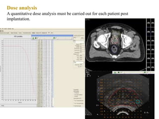 Dose analysis
A quantitative dose analysis must be carried out for each patient post
implantation.
 