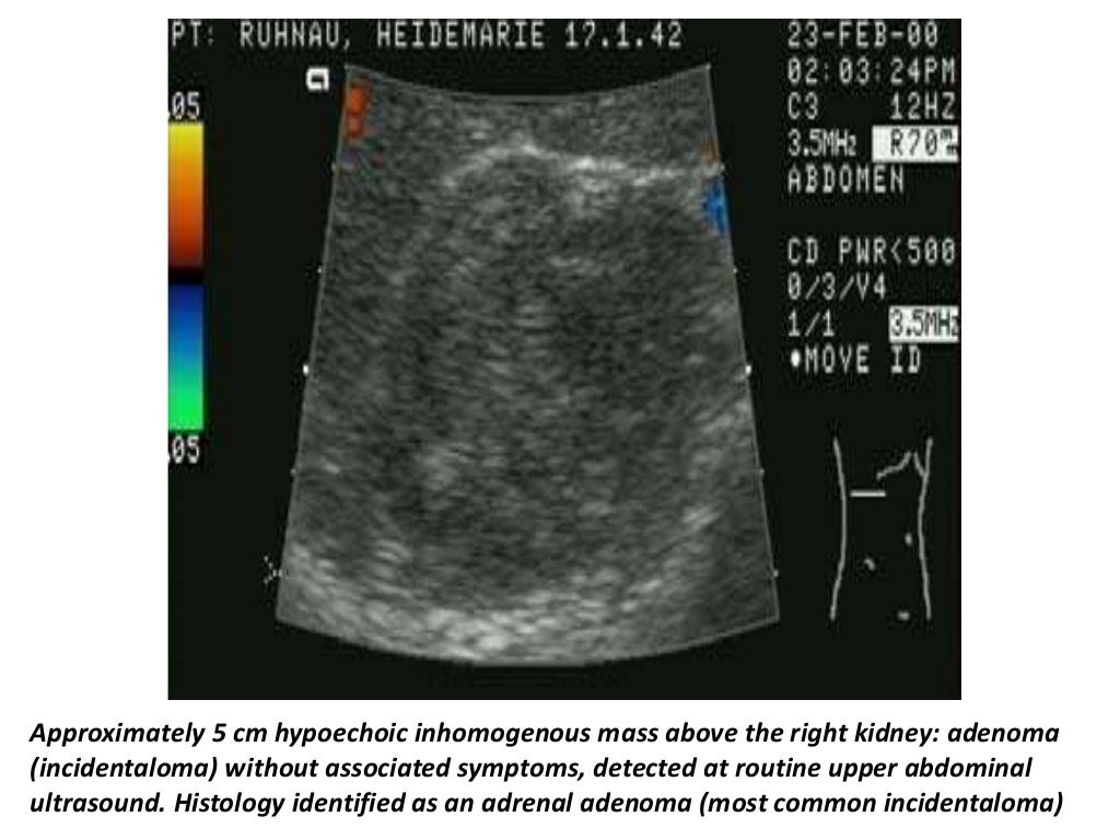 Presentation1.pptx, ultrasound examination of the adrenal glands and