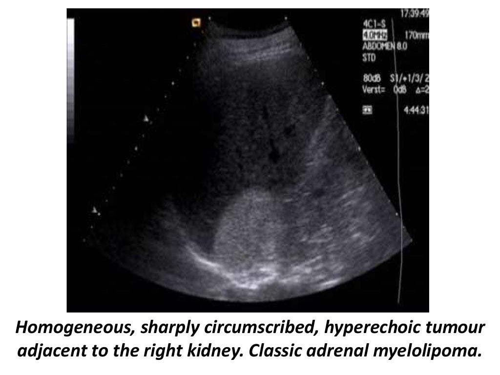 Presentation1.pptx, ultrasound examination of the adrenal glands and