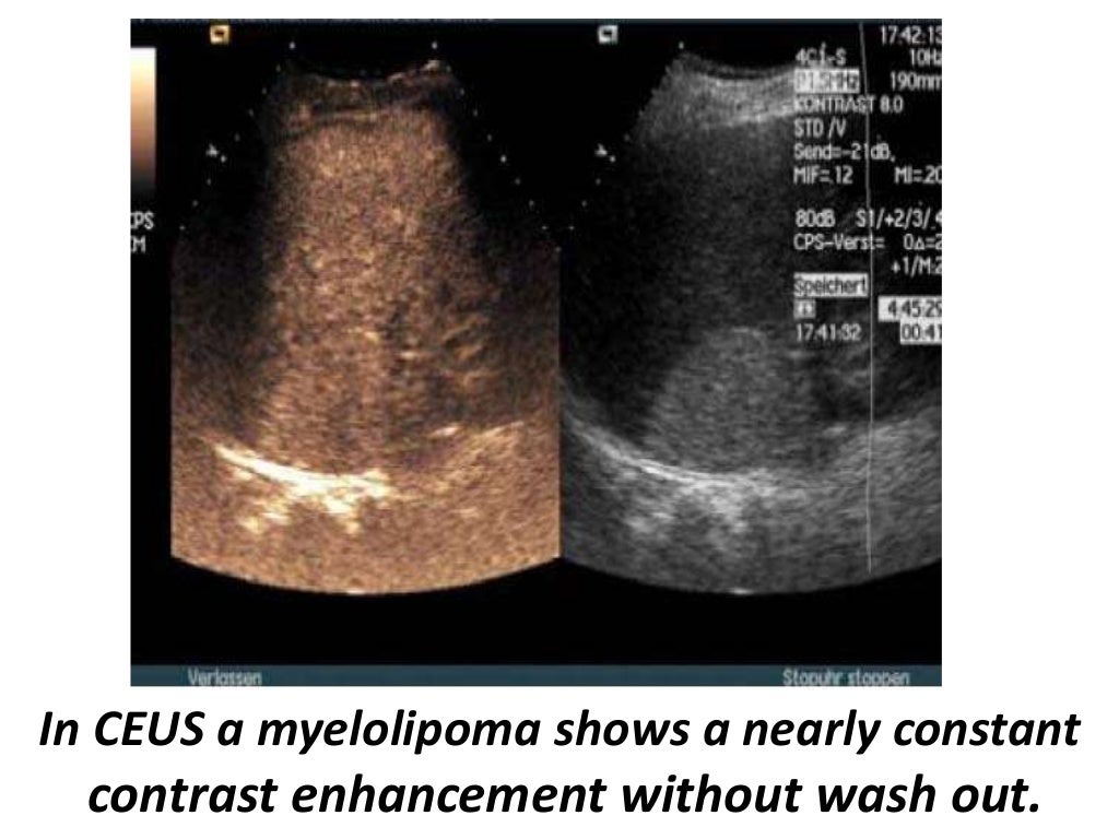Presentation1.pptx, ultrasound examination of the adrenal glands and
