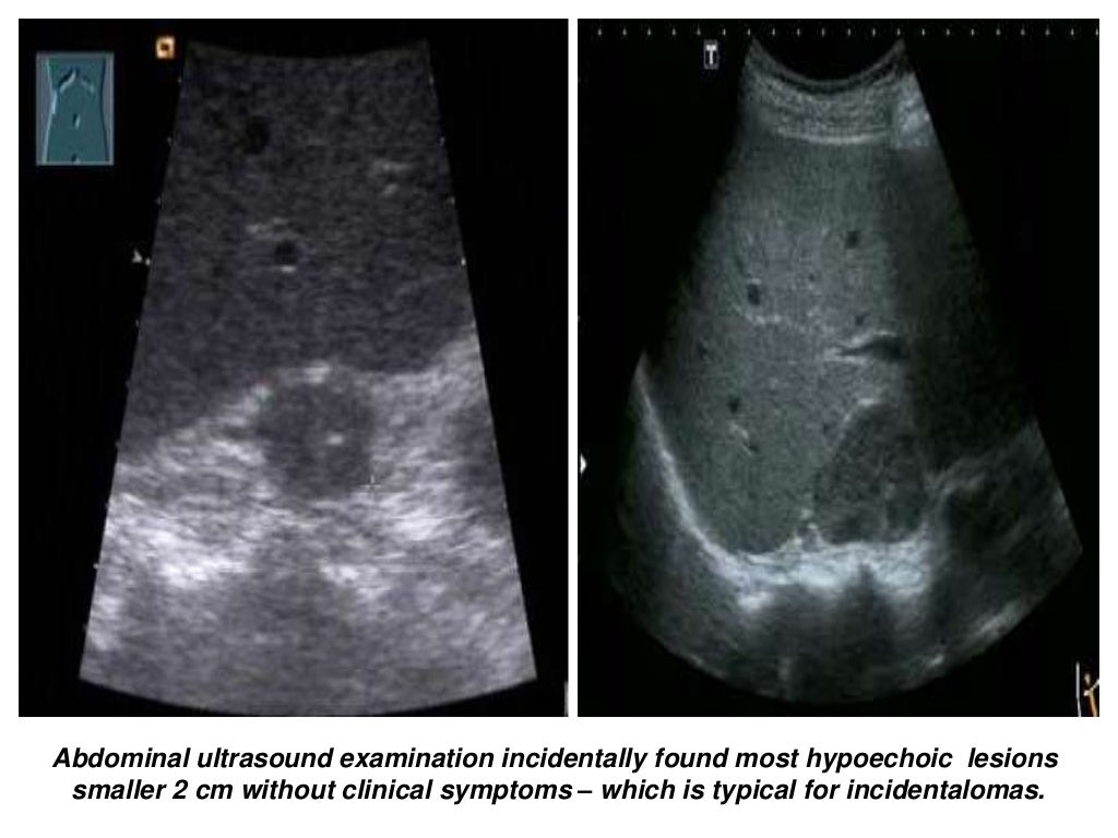 Presentation1.pptx, ultrasound examination of the adrenal glands and