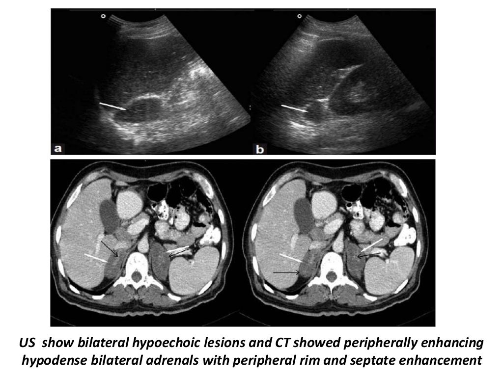 Presentation1.pptx, ultrasound examination of the adrenal glands and
