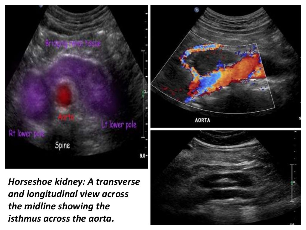 Presentation1.pptx, ultrasound examination of the adrenal glands and
