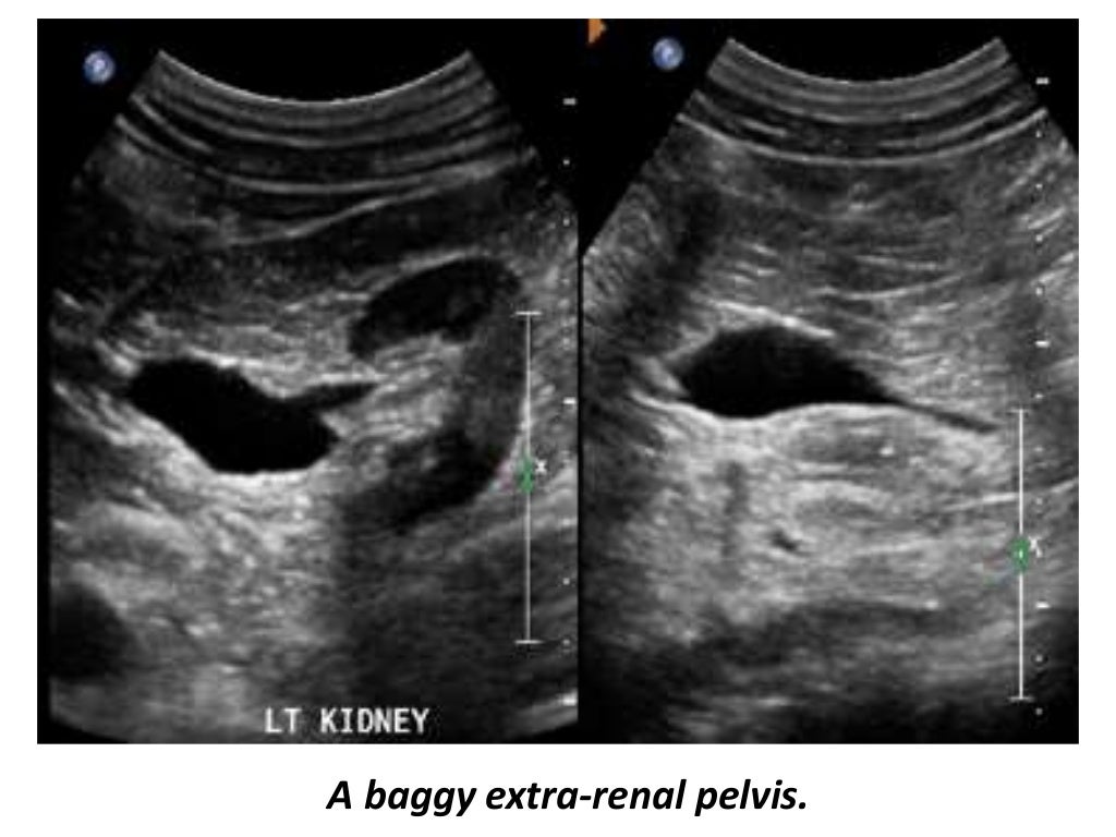 Presentation1.pptx, ultrasound examination of the adrenal glands and