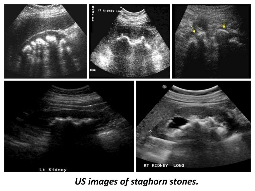 Presentation1.pptx, ultrasound examination of the adrenal glands and