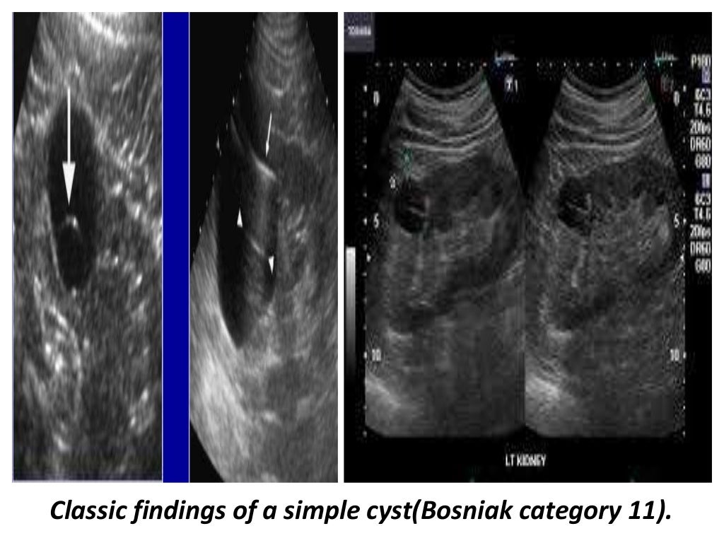 Presentation1.pptx, ultrasound examination of the adrenal glands and