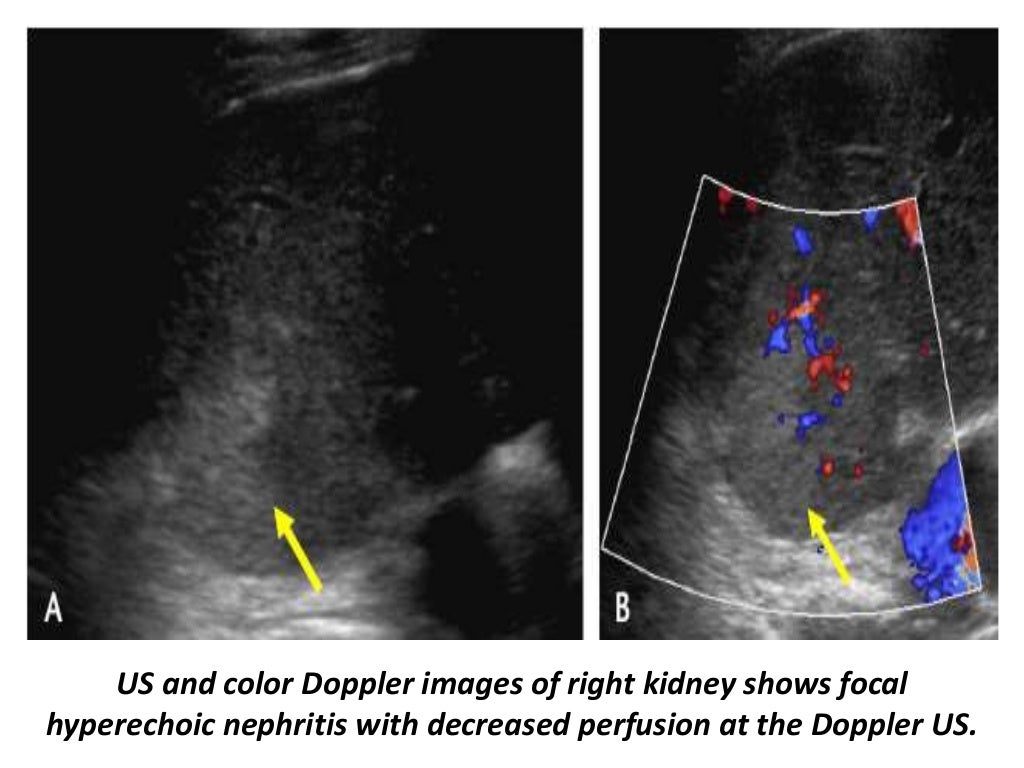 Presentation1.pptx, ultrasound examination of the adrenal glands and