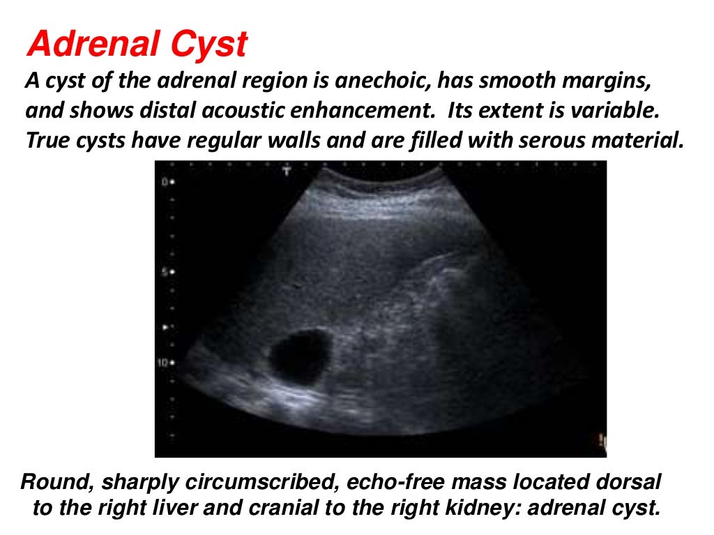 Presentation1.pptx, ultrasound examination of the adrenal glands and