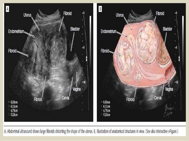 uterus ovaries presentation1 pptx