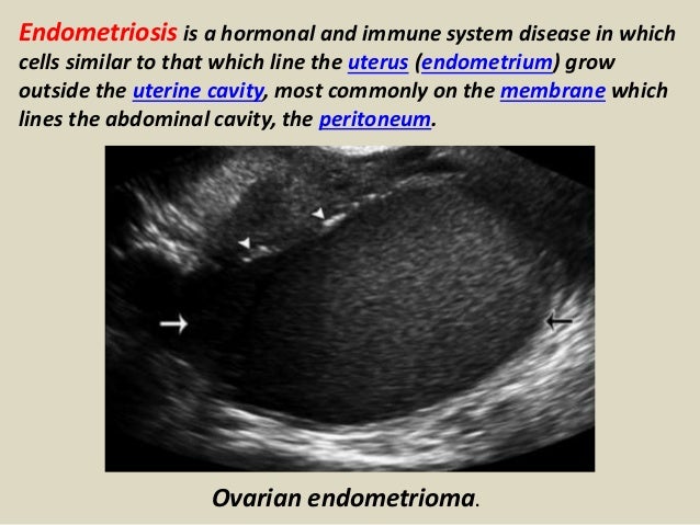 Presentation1.pptx, ultrasound examination of the uterus and ovaries.