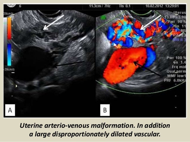 ultrasound ovaries uterus dilated malformation presentation1 bladder pptx arterio