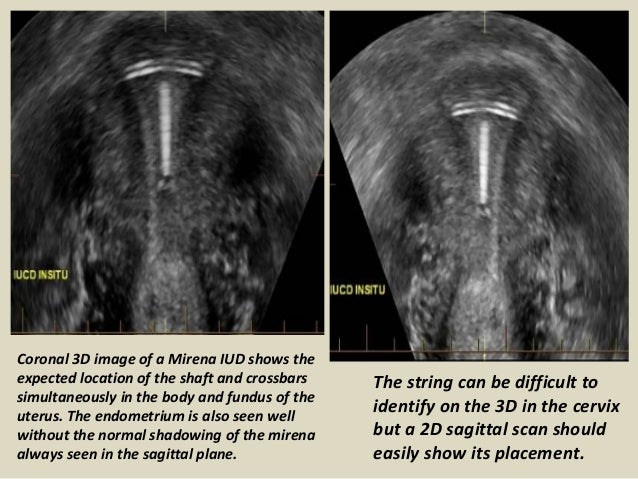 Presentation1.pptx, ultrasound examination of the uterus and ovaries.