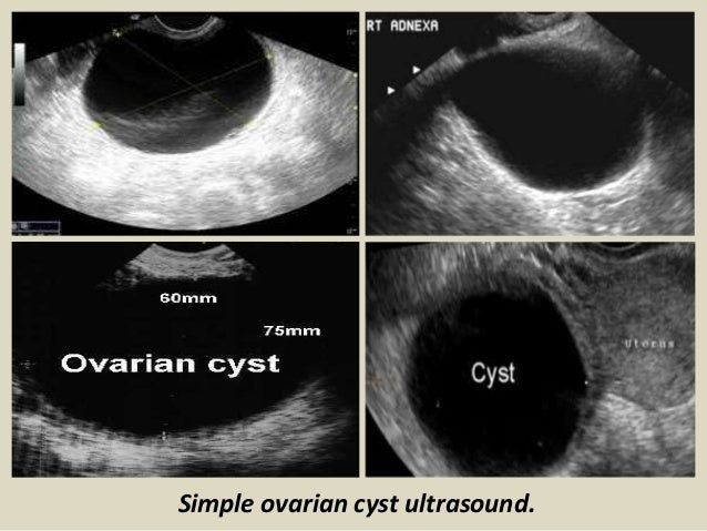 Presentation1.pptx, ultrasound examination of the uterus and ovaries.
