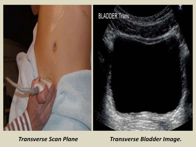 Presentation1.pptx, ultrasound examination of the urinary bladder and ...