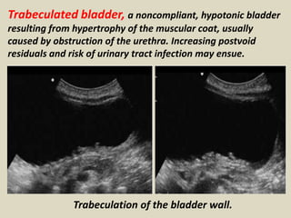 Presentation1.pptx, ultrasound examination of the urinary bladder and  prostate.