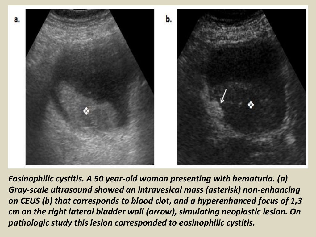Presentation1.pptx, ultrasound examination of the urinary bladder and…