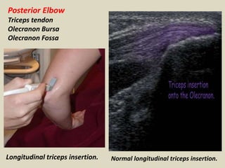 Posterior Elbow
Triceps tendon
Olecranon Bursa
Olecranon Fossa
Longitudinal triceps insertion. Normal longitudinal triceps insertion.
 