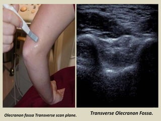 Olecranon fossa Transverse scan plane. Transverse Olecranon Fossa.
 