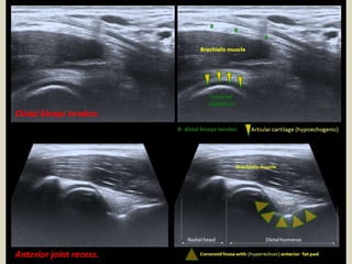 Distal biceps tendon.
Anterior joint recess.
 