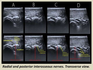 Radial and posterior interosseous nerves. Transverse view.
 