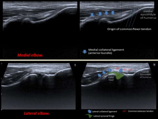 Medial elbow.
Lateral elbow.
 