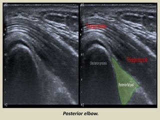 Posterior elbow.
 