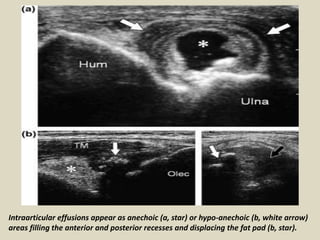Intraarticular effusions appear as anechoic (a, star) or hypo-anechoic (b, white arrow)
areas filling the anterior and posterior recesses and displacing the fat pad (b, star).
 