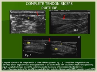 Presentation1.pptx, ultrasound examination of the elbow joint.