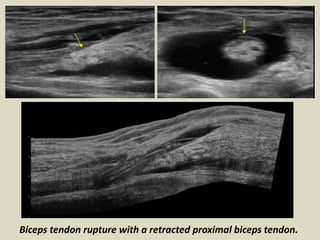Biceps tendon rupture with a retracted proximal biceps tendon.
 